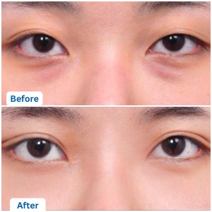 Upper Blepharoplasty