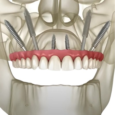 Zygomatic implants