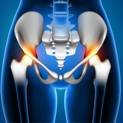 Medical diagram of arthritis on both the hips