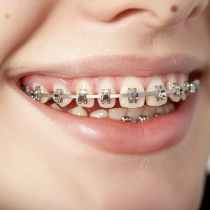 teeth with braces