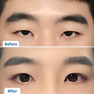 Eyelid Surgery for Men