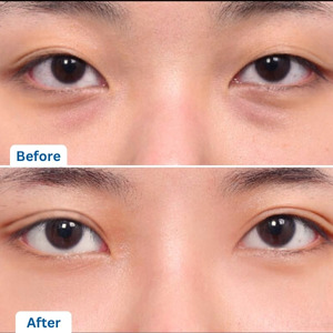 Under Eye Fat Removal Surgery