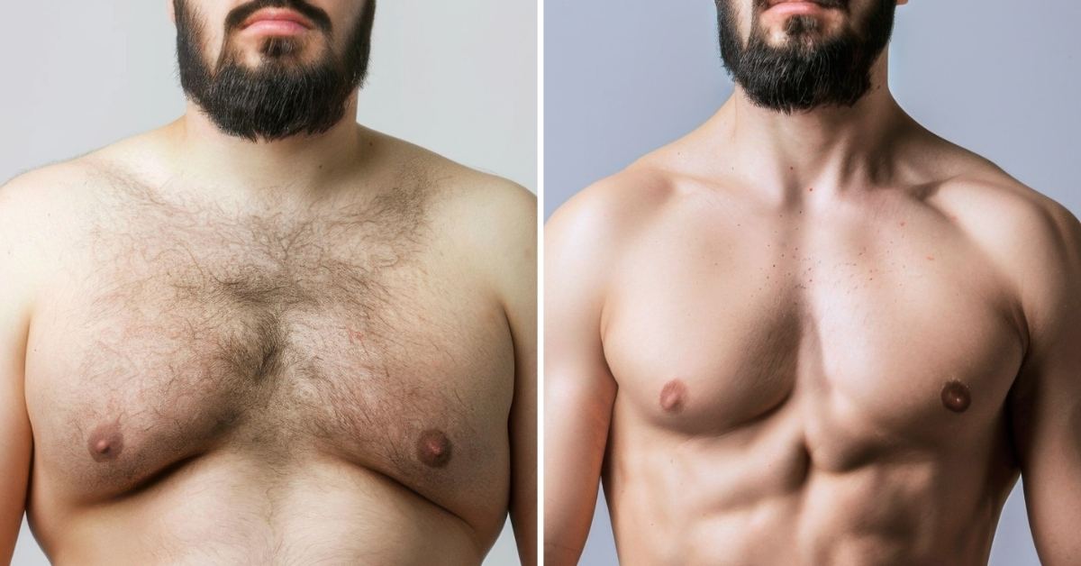 Gynecomastia Correction in Seoul, Korea