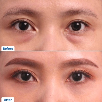 Under Eye Fat Removal