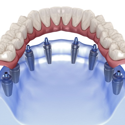 All on 8 Dental Implants