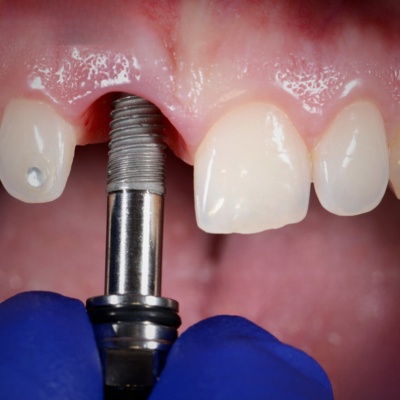 dental implant