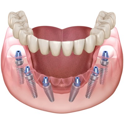 3-on-6 dental implant