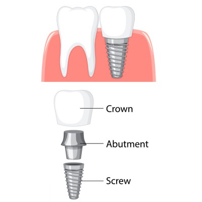 parts of a dental implant