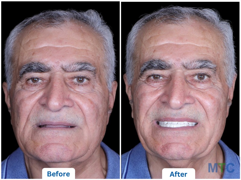  Full mouth dental implants in Bangalore: before image with missing teeth and after image with a restored, natural-looking smile.