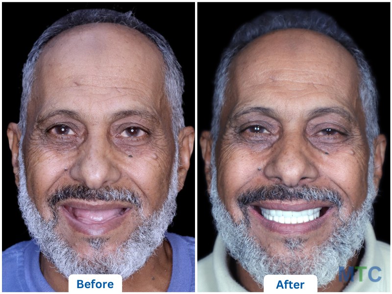  Full mouth dental implants in Bangalore: before image with missing teeth and after image with a restored, natural-looking smile.