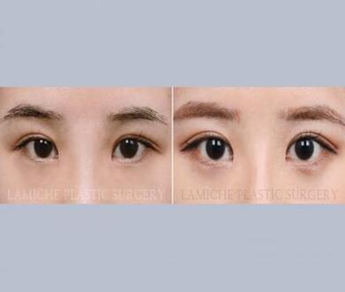 Lamiche Plastic surgery Clinic, Forehead Correction Procedure Package Card