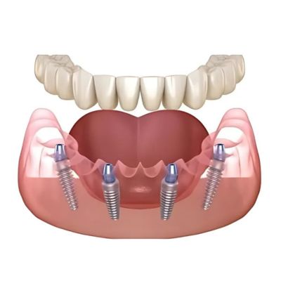 All-on-4 implants