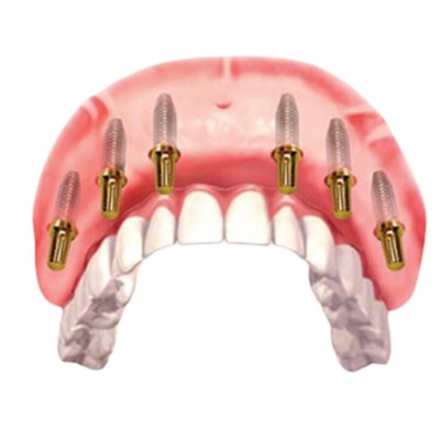 All on 6 Dental implants