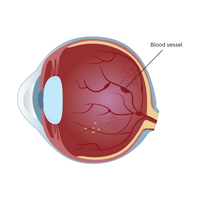 Hemorrhage from diabetic retinopathy