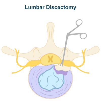 Discectomy - Type of Lumbar Decompression Surgery