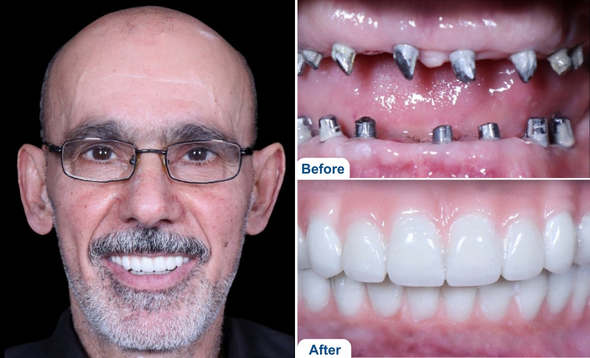 Full Mouth Dental Implants in Bangalore