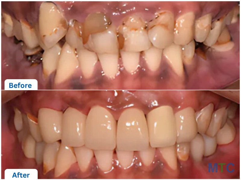 Full Mouth Rehabilitation - Crowns; before and after