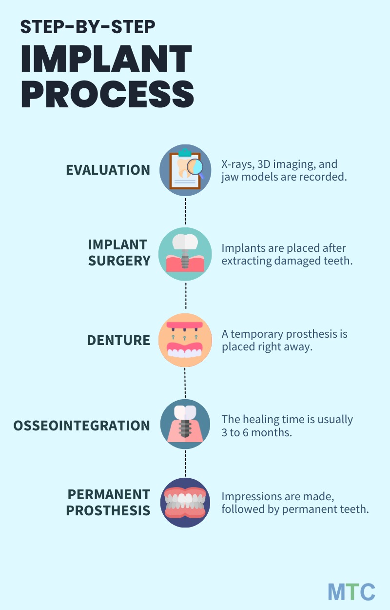 Getting Full Mouth Implants