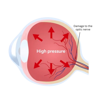 Neovascular glaucoma