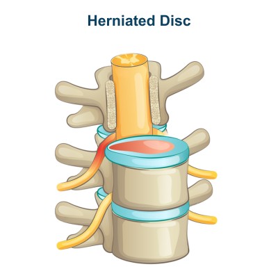 Herniated Disc - Bulging Disc Pressing on the Nerves