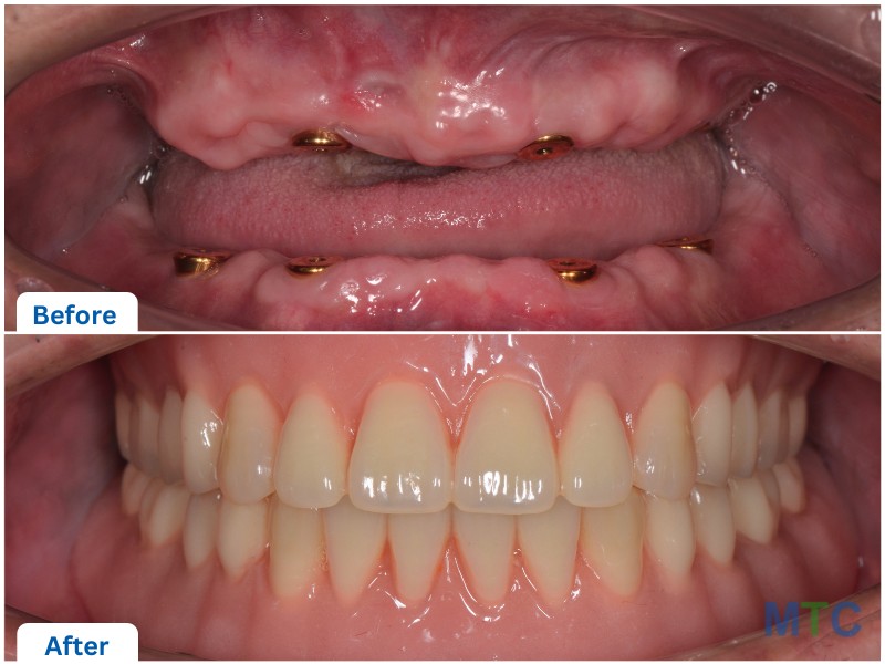 Full Mouth Dental Implants before and after image