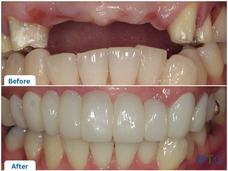 Dental Implants - Front Region before and after