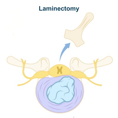 Laminectomy Surgery - Type of Lumbar Decompression Surgery