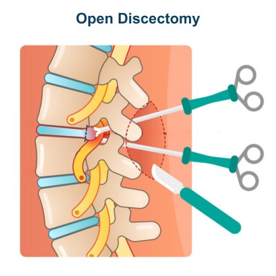 Revision Spine Surgery - Open Discectomy