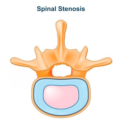 Spinal Stenosis - Compressing Spinal Cord Nerves