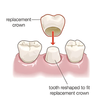 Replacement dental crown being fitted on prepared teeth.