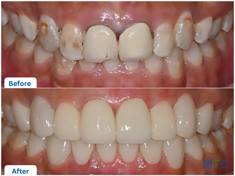 Dental veneers before and after images