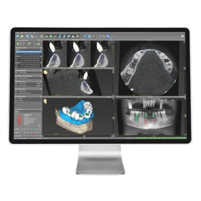 Virtual Implant Planning Software