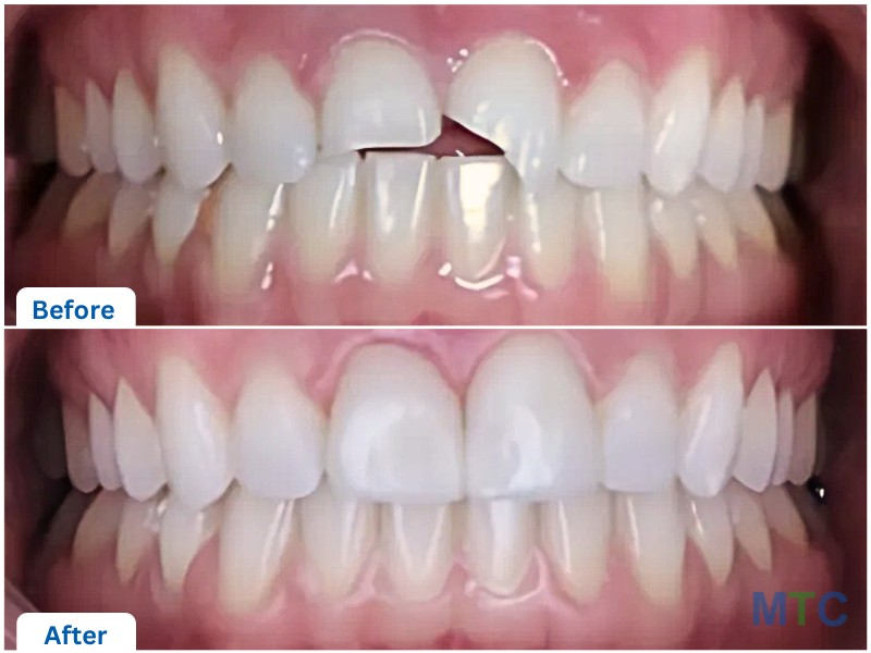 before and after smile restoration