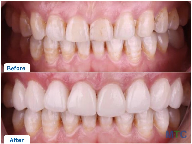 before and after cosmetic dental procedures