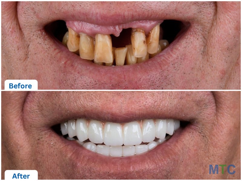 before & after dental implants