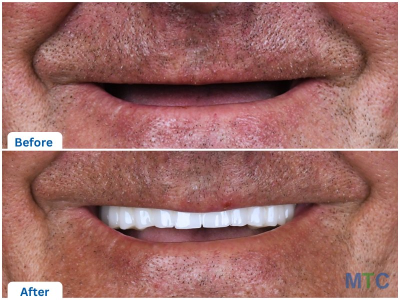 before & after dental implants