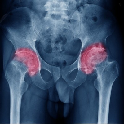 X-Ray Showing Osteoarthritis