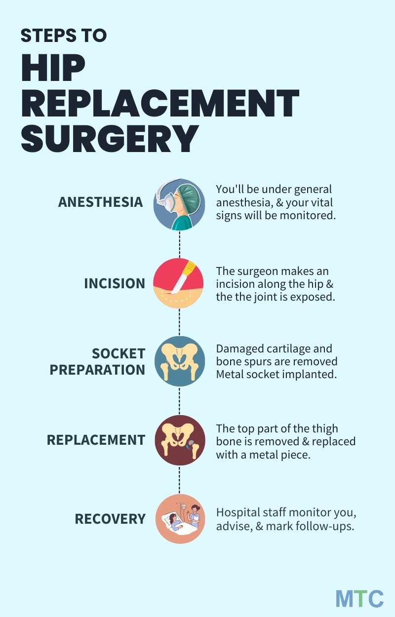 Steps to Hip Replacement Surgery