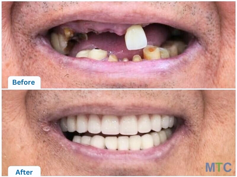 Close up of Full mouth restoration with dental implants