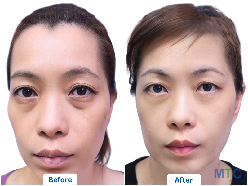 Lower Blepharoplasty