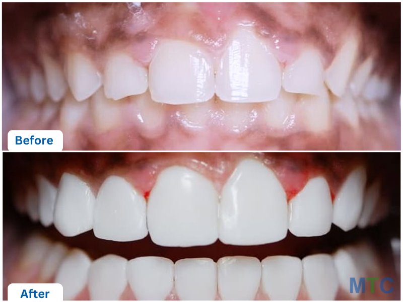 Dental Veneers in Bali, Indonesia