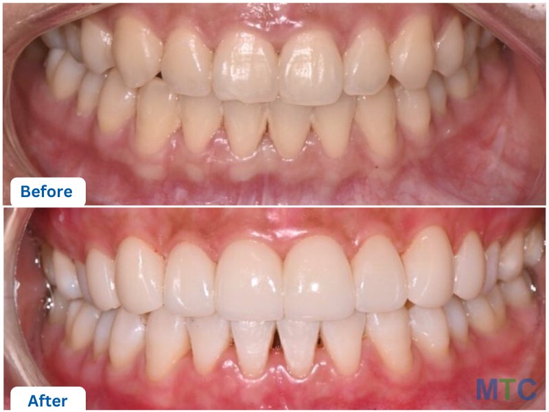 Side-by-side comparison of teeth showing a significant transformation. The top image (Before) displays teeth with discoloration, uneven alignment, and some wear. The bottom image (After) shows teeth that are whiter, more evenly aligned, and have a polished, healthy appearance.