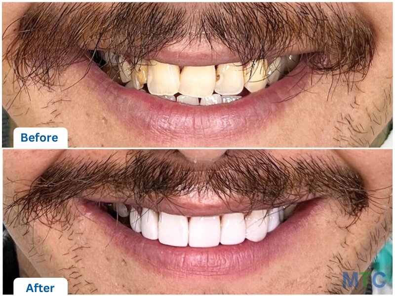 Dental Veneers