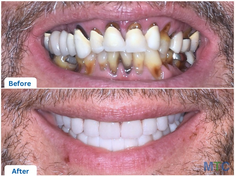 Close up of before and after full mouth restoration with dental implants