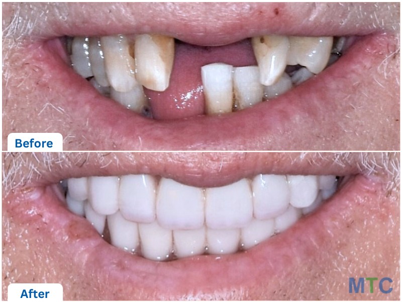 Close up of before and after full mouth rehabilitation with dental implants