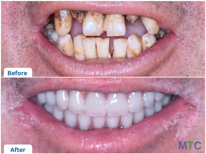 close up of before and after full mouth restoration with dental implants