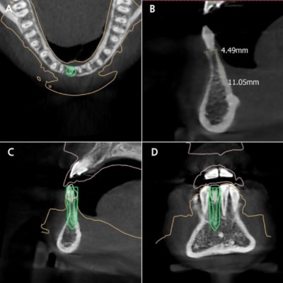 Implant planning using CBCT. (A) Occlusal view, (B) Sagittal view, (C) Sagittal view showing implant placement, (D) Coronal view showing implant placement.