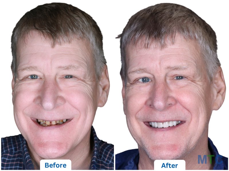 before after image of dental veneers in bangalore