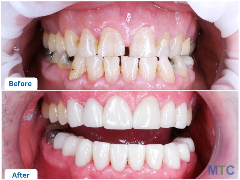 Before and After Dental Crowns & Veneers