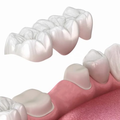 Dental bridge